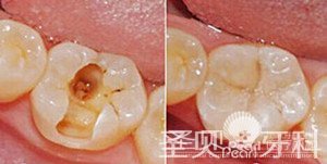 成都儿童龋齿应如何治疗2