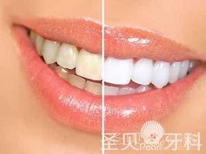 牙齿美白医院去哪家好2